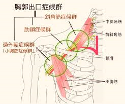 胸郭出口症候群とは？？　京都市北区北大路　北大路東洋鍼灸整骨院