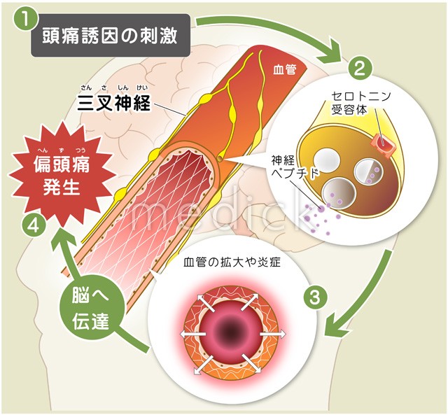 沢山ある！！頭痛の種類 京都市北区・左京区 北大路東洋鍼灸整骨院 - 北大路東洋鍼灸整骨院