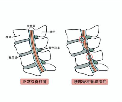 脊柱管狭窄症　　腰の痛み　足の痺れ　京都市北区/左京区　北大路東洋鍼灸整骨院