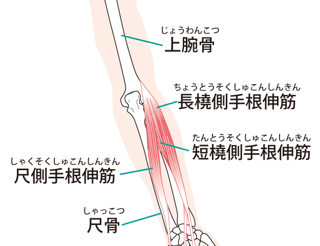肘の痛み　外側上顆炎　腕の使い過ぎ　肘の外側の痛み　京都市北区/左京区　北大路東洋鍼灸整骨院