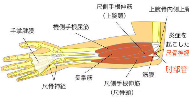 肘部管症候群　肘の痛み　指先の痺れ　京都市北区/左京区　北大路東洋鍼灸整骨院